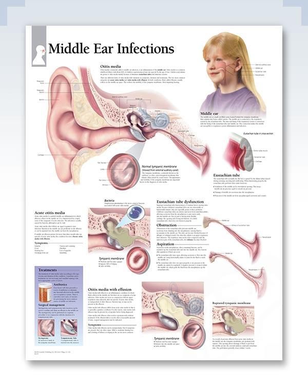 Middle Ear Infections Chart 22x28