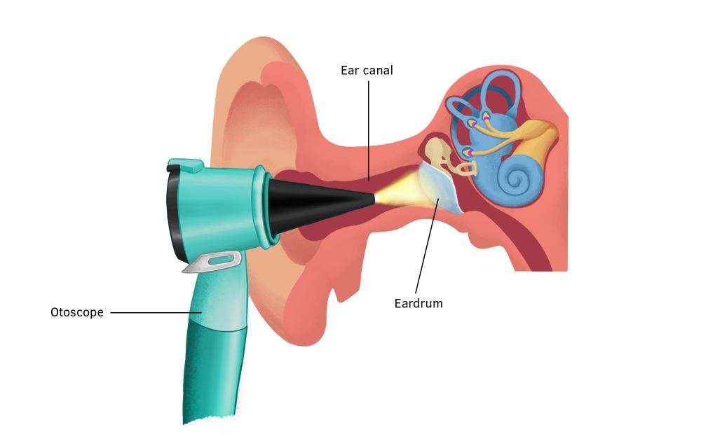 Middle ear infections