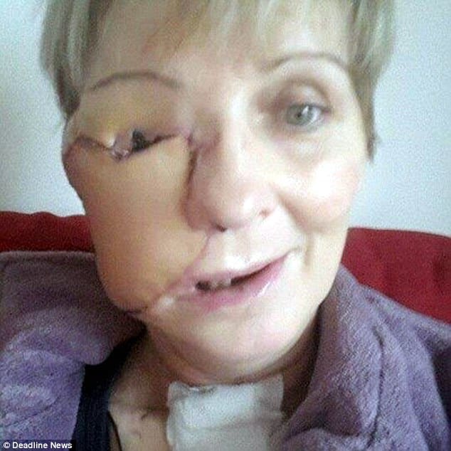Mother whose face was ravaged by cancer bravely releases images of her ...