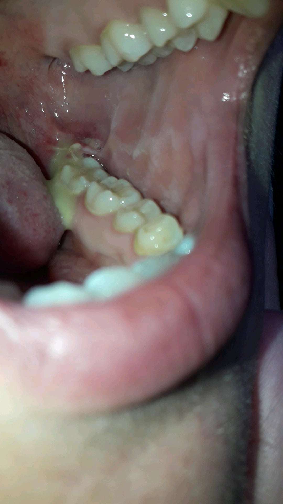 My abscess from a wisdom tooth extraction has started to ...
