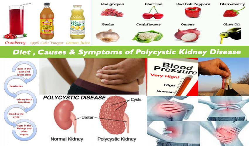 Natural Health And Beauty Tips: Get Best Polycystic Kidney Disease ...