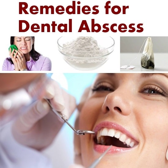 Natural Home Remedies for Dental Abscess