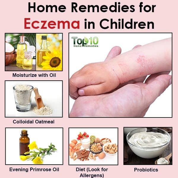 Natural Remedies for Eczema in Children