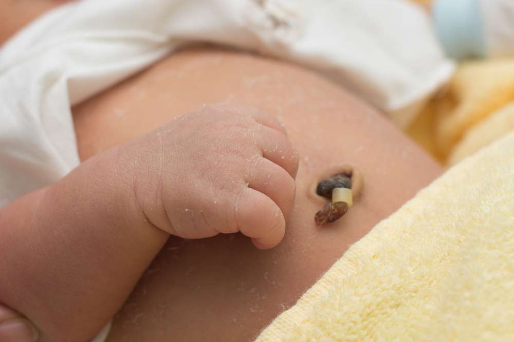 Newborn Baby Umbilical Cord Infection