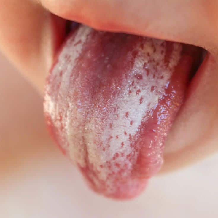 Oral Thrush &  18+ Natural Treatments to Relieve It