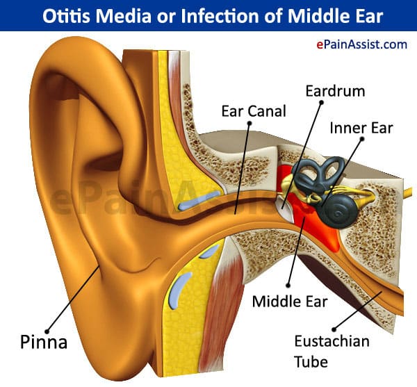 Otitis Media or Infection of Middle Ear