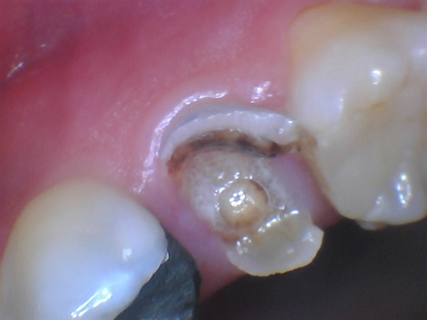 Pain After Tooth Extraction