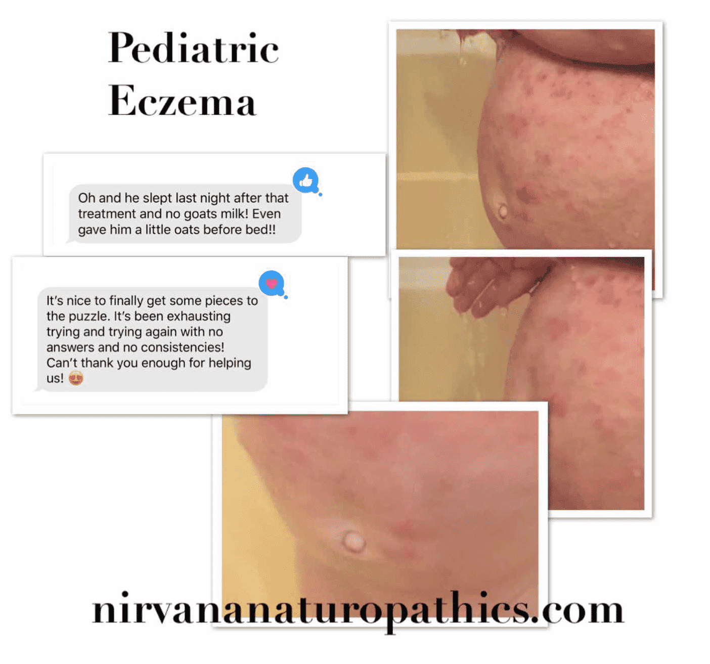 Pediatric Eczema