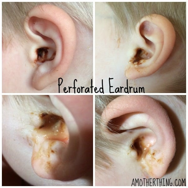 Perforated Eardrum in Toddlers