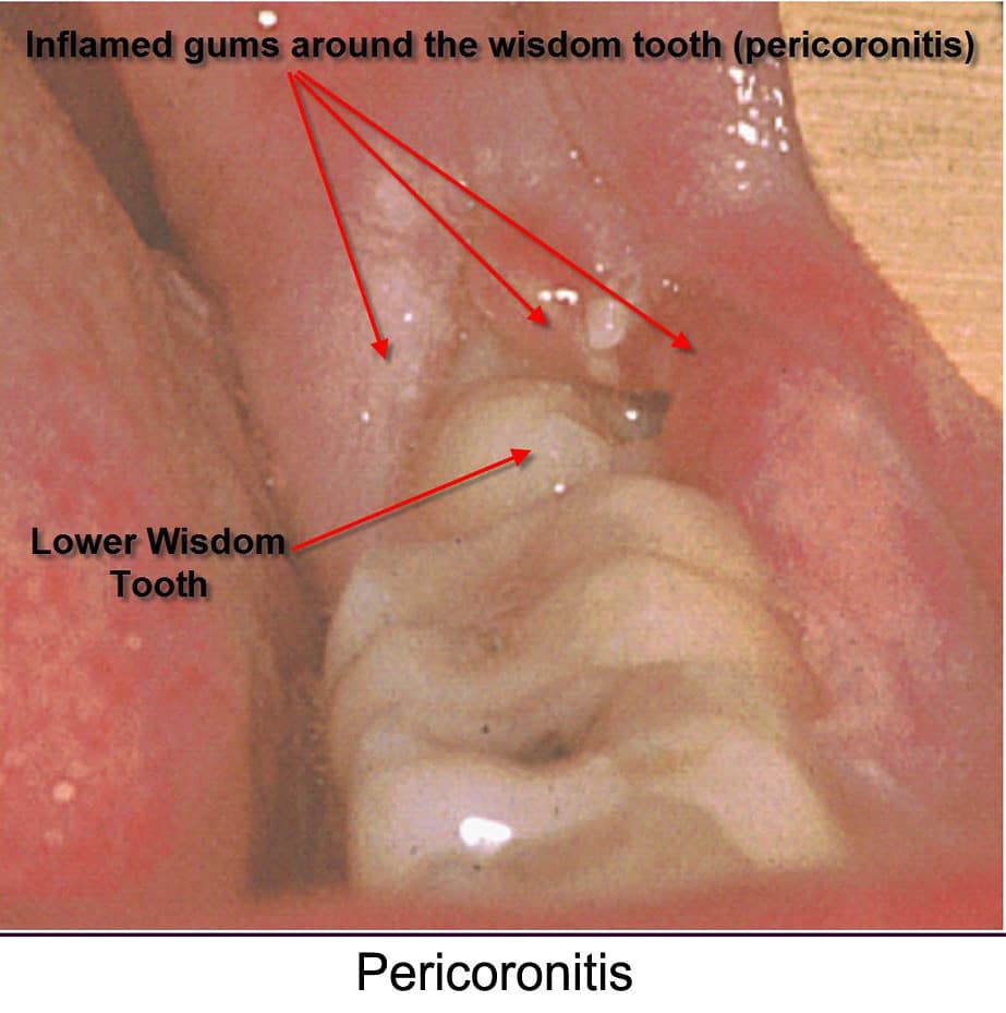 Pericoronitis_around_left_lower_wisdom_tooth