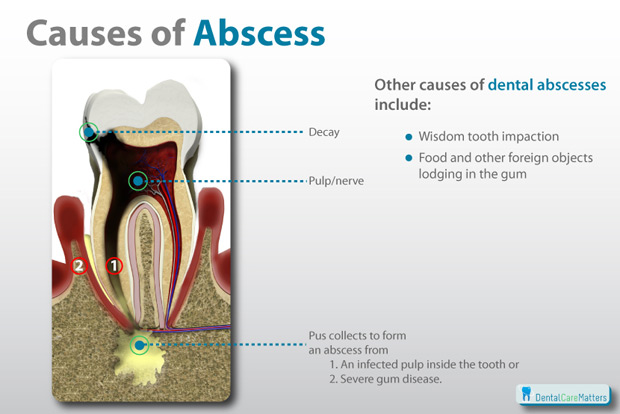 Periodontal Abscess  Causes, Symptoms and Treatment ...