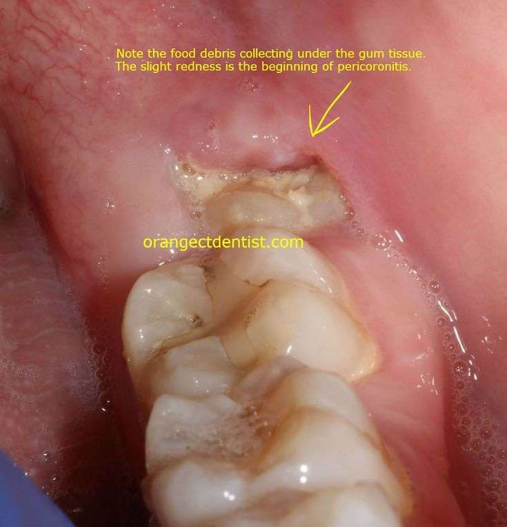 Photo of early stage pericoronitis of a lower left wisdom to...