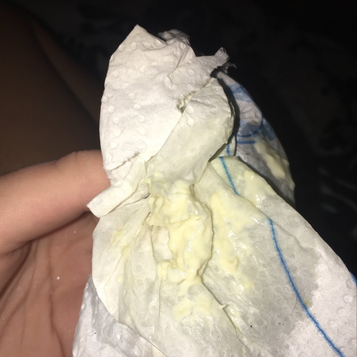 Picture Of Yeast Infection Discharge