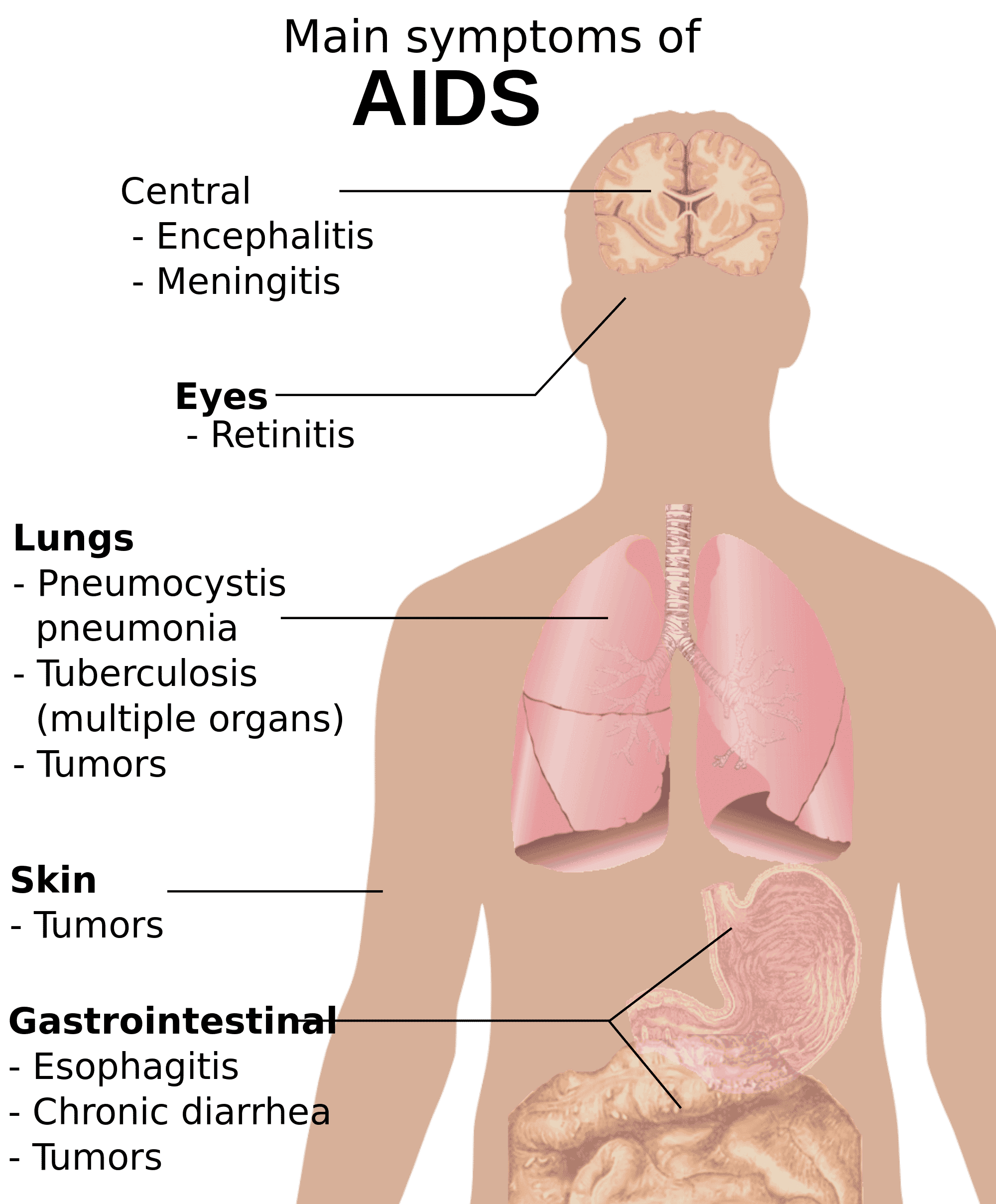 Pin on HIV/AIDS Infographics