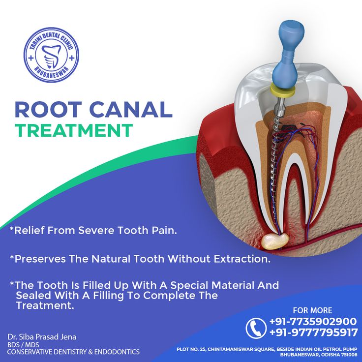 Pin on Root canal treatment