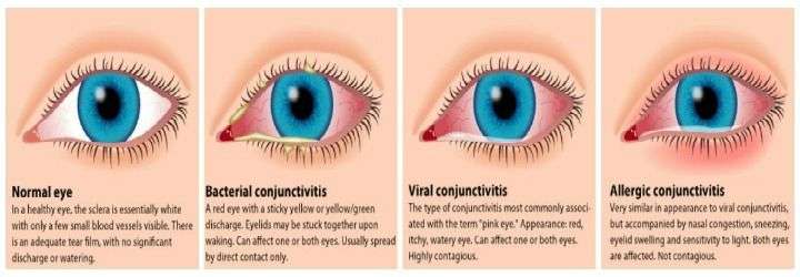 Pink Eye (Conjunctivitis)  Causes &  Home Remedies ...