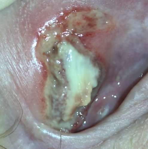 Please help! Possible infects thrush sores?