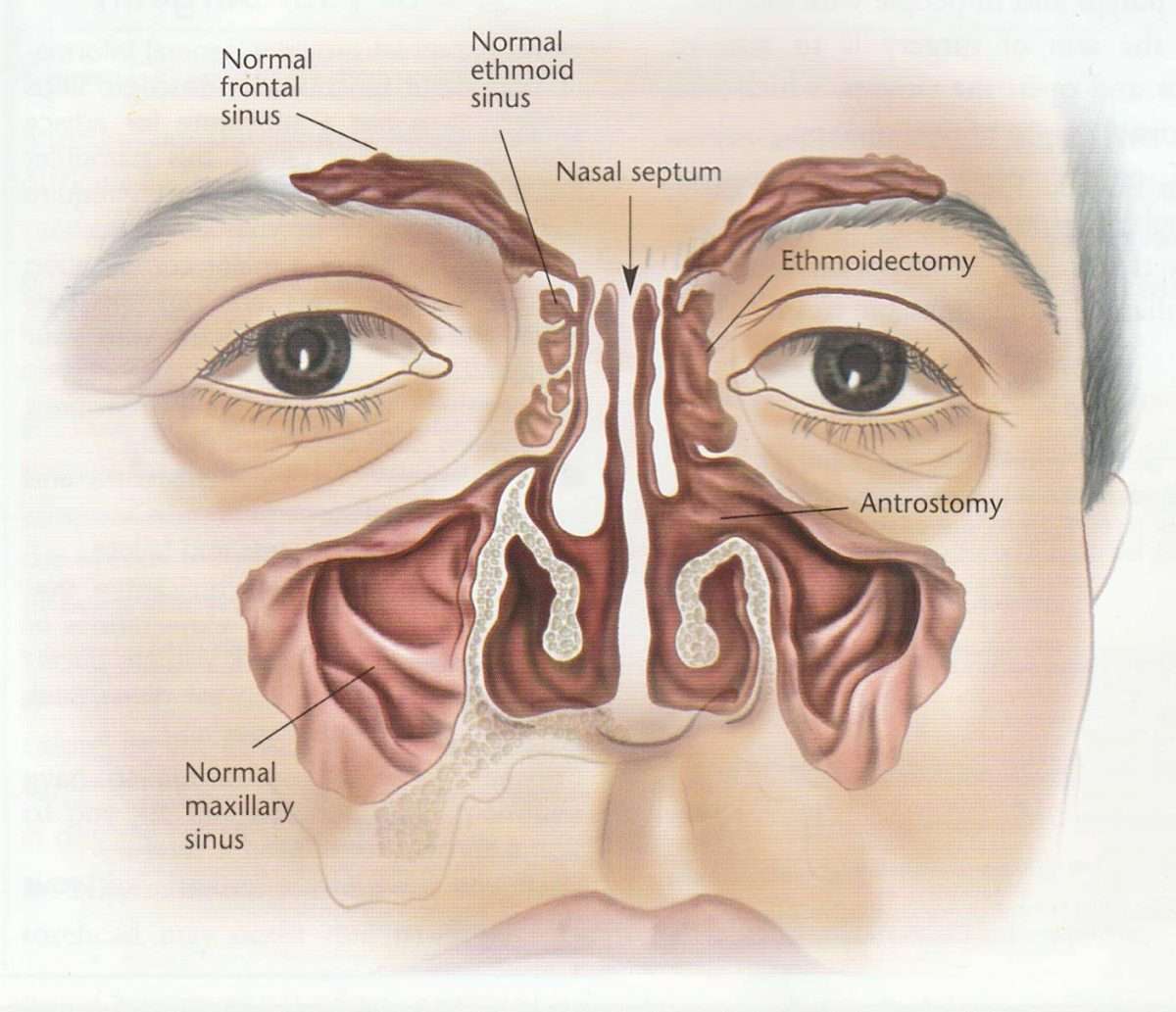 Procedure For Nasal Polyps Operation Learn More Here Now.