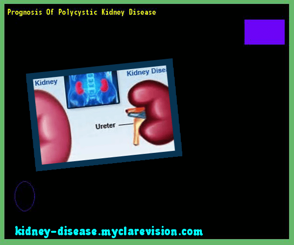 Prognosis Of Polycystic Kidney Disease 103150