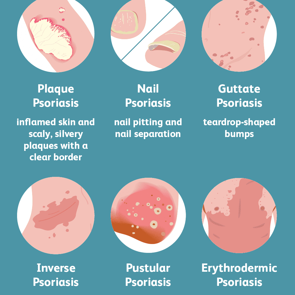 Psoriasis: the reality of this common disease of the skin