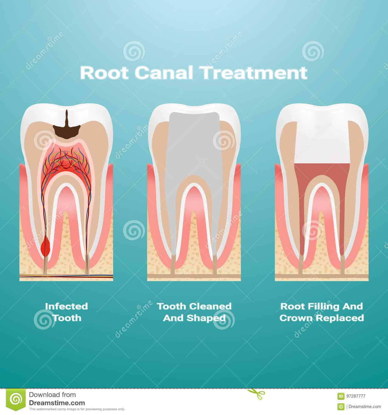 Pulpitis And Healthy Tooth Vector Illustration