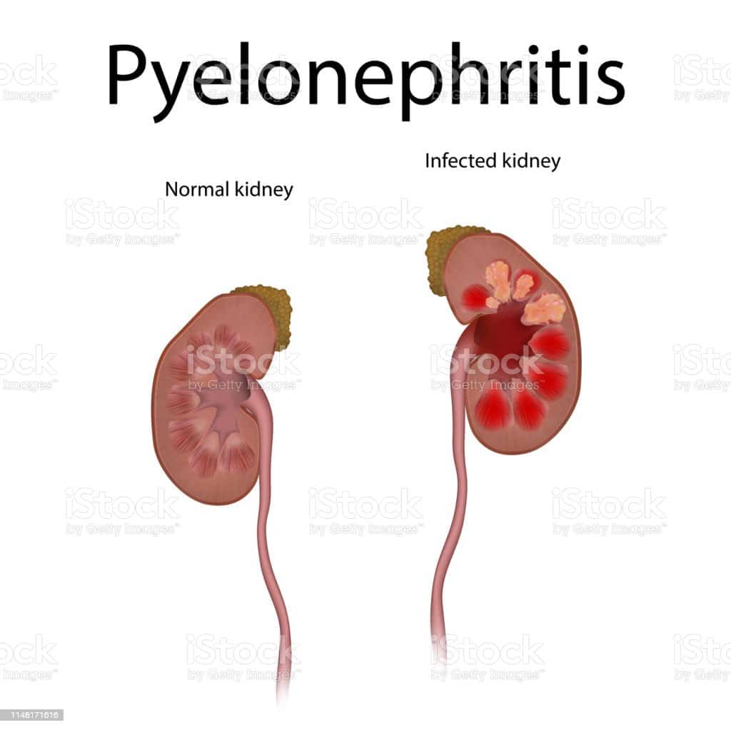 Pyelonephritis Kidney Infection Infected Normal Healthy Realistic ...