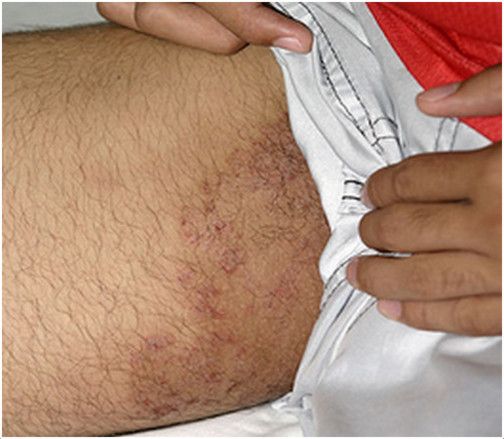 Rash On Inner Thighs  Causes, Symptoms, Treatment, Pictures, Home ...