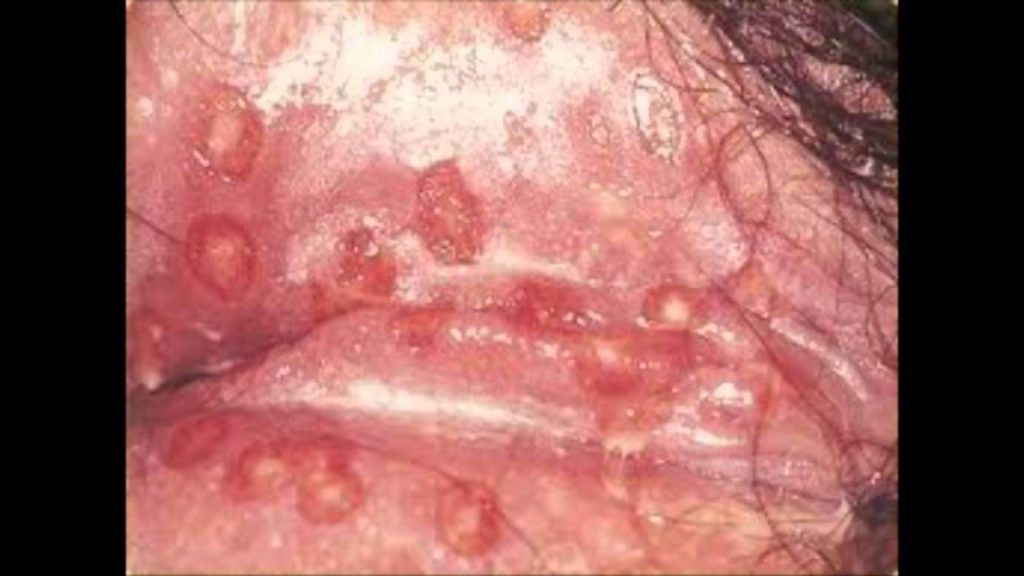 Really Bad Yeast Infection