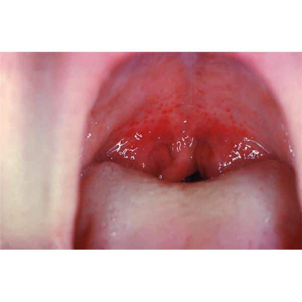 Recurrent, Chronic Strep Throat: Symptoms, Diagnosis &  Treatment of ...