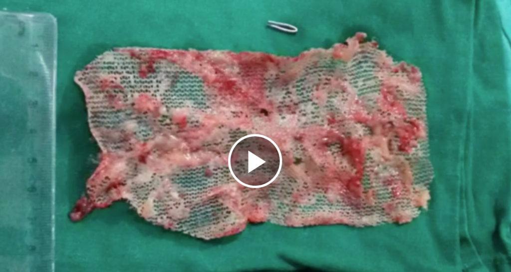 Removing Infected Hernia Mesh