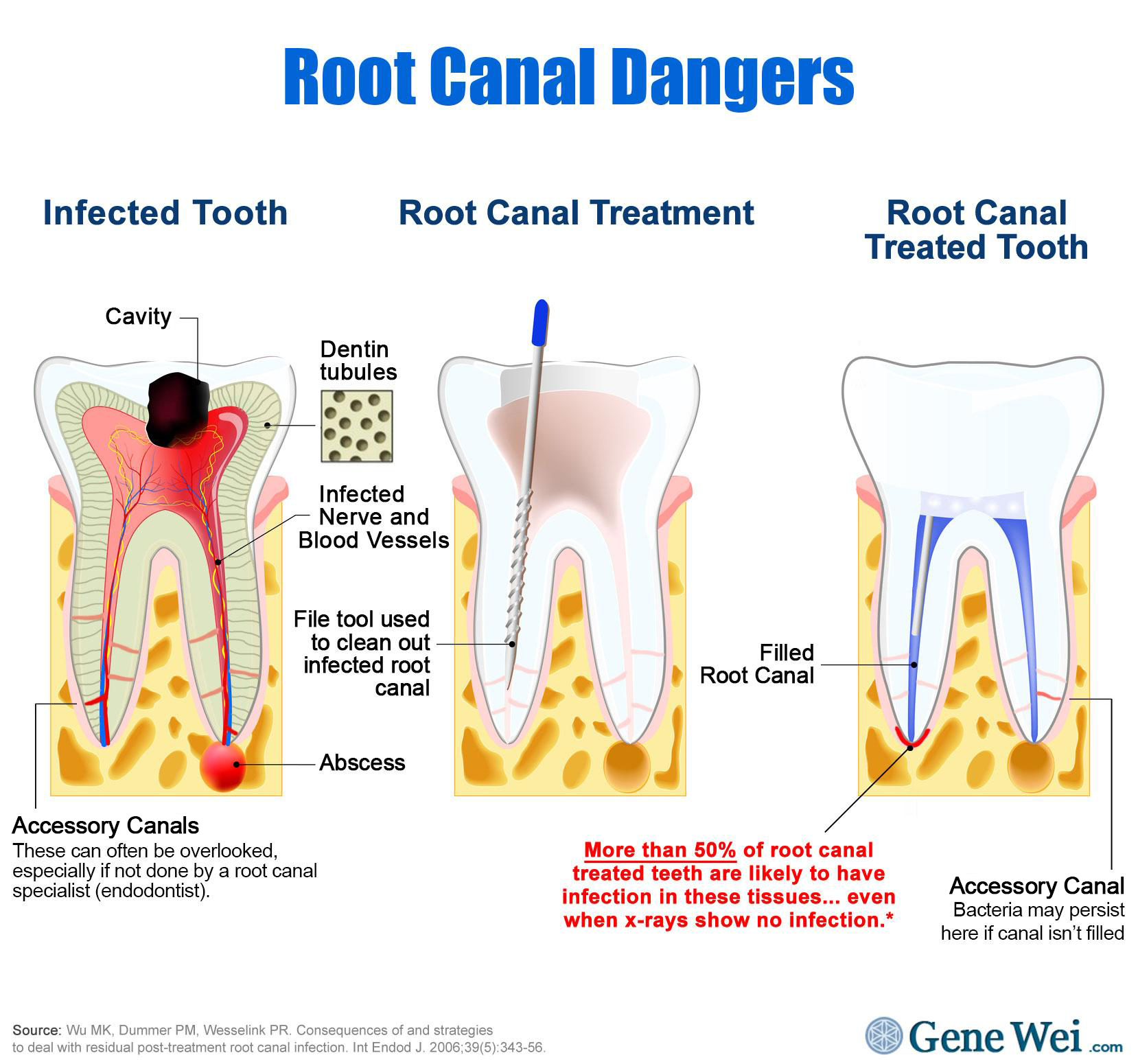 Root Canal Complications Symptoms