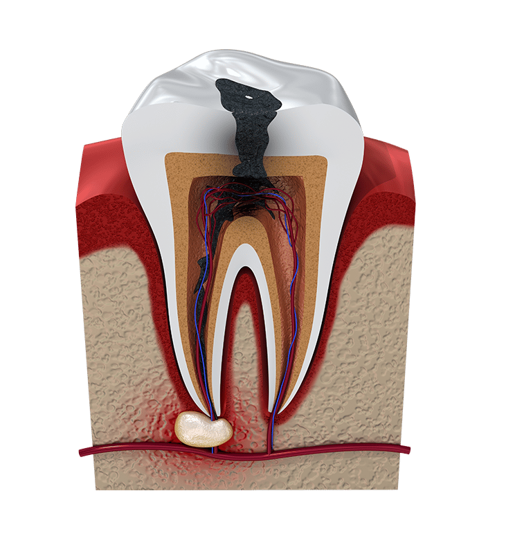 Root Canal Infection and Tooth Loss