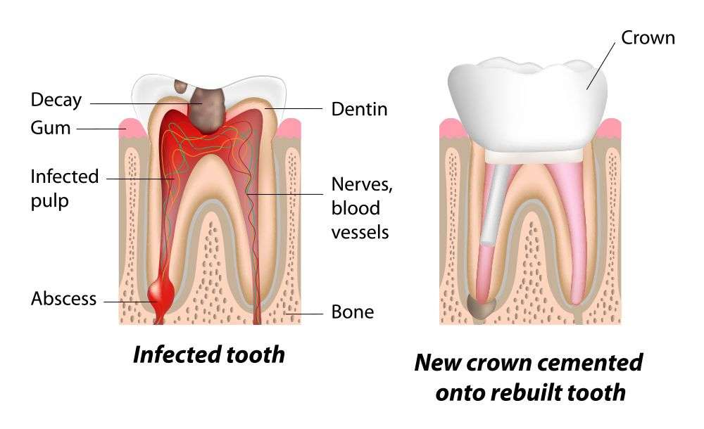 Root Canal Infection Symptoms