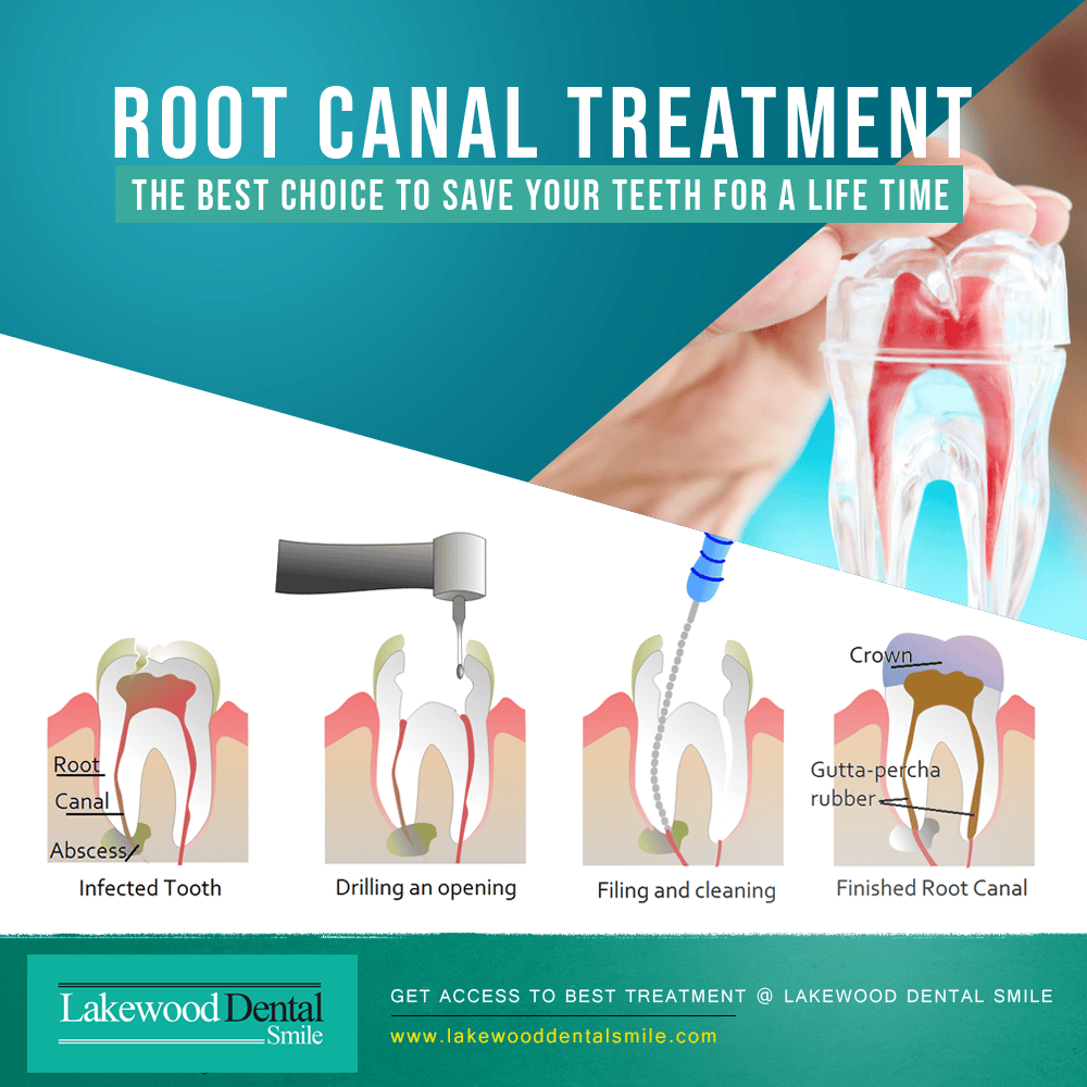 Root Canal Therapy Dearborn, MI