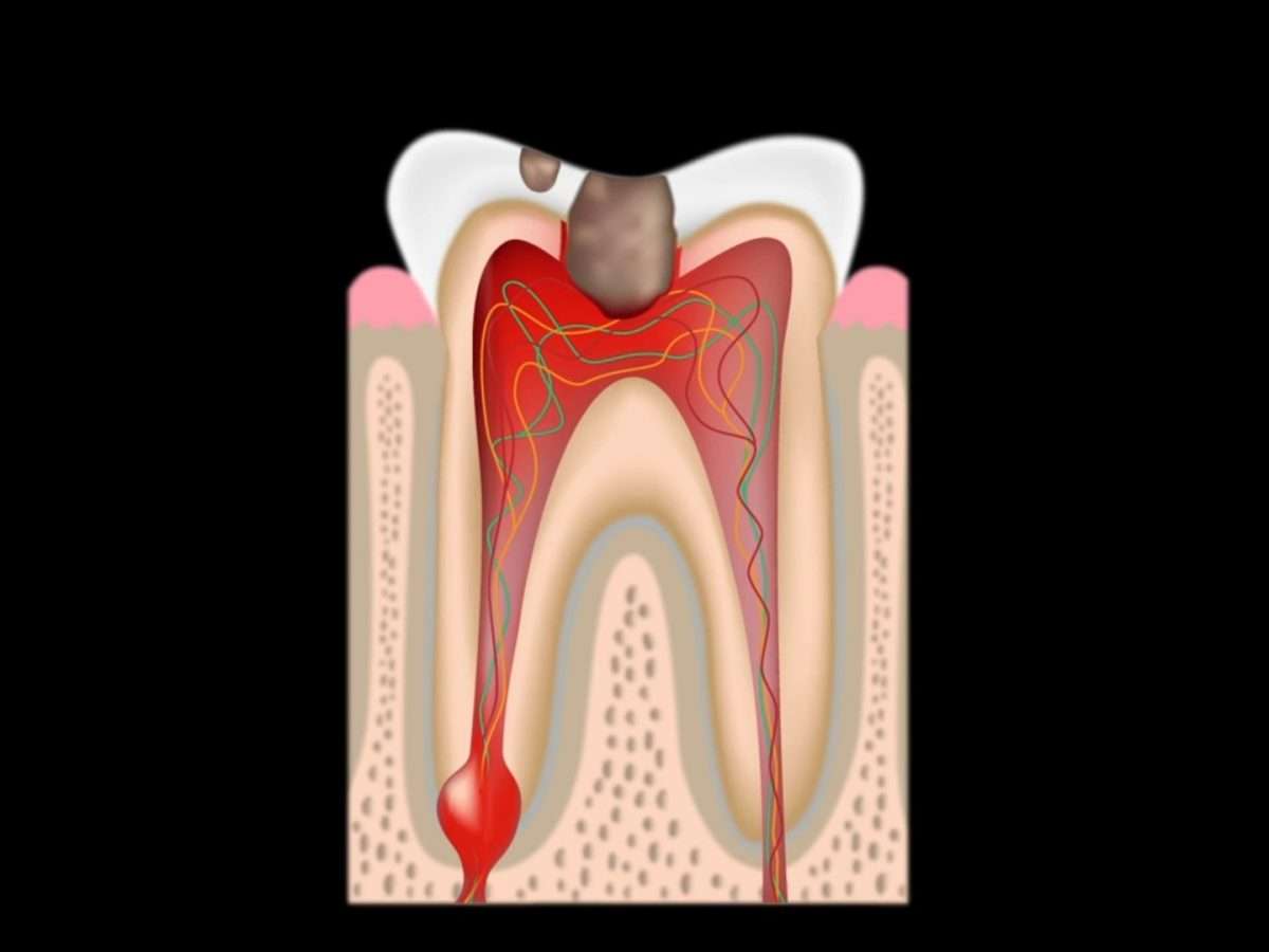 Root Canal Treatment: Healthy Smiles