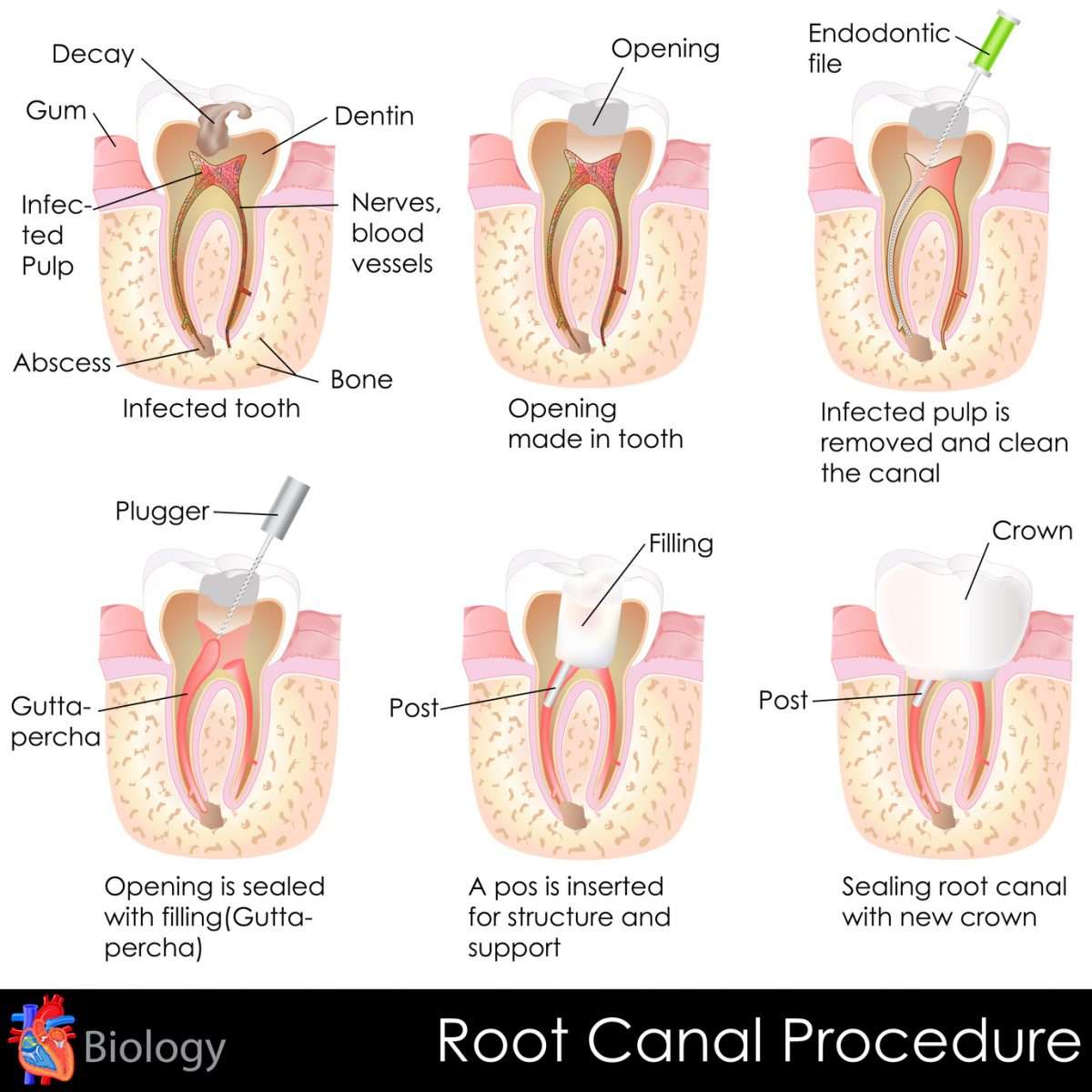 Root Canal Treatment in Welland