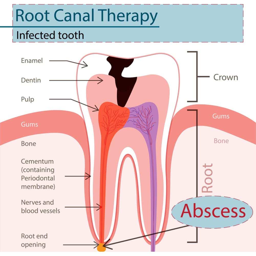 Root Canal Treatment  Klein Family Dental