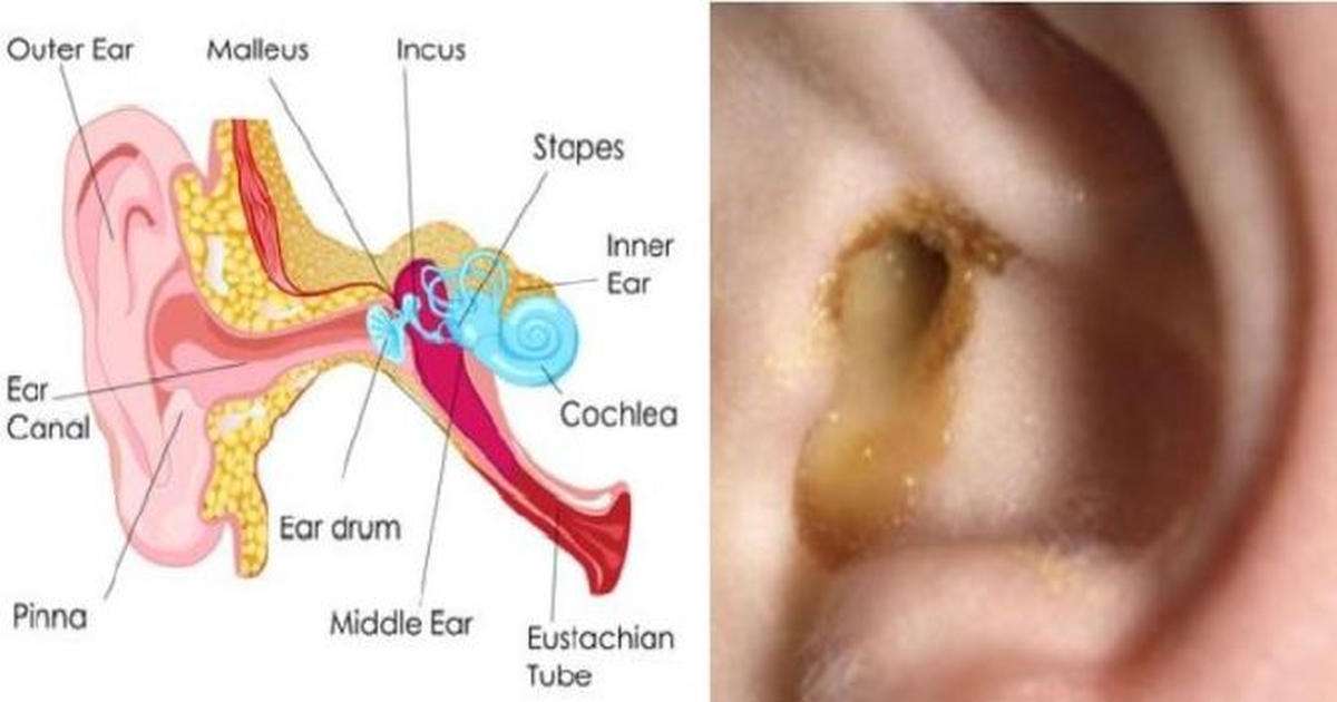 Say Goodbye To Ear Infection! Heres How to Cure An Ear ...