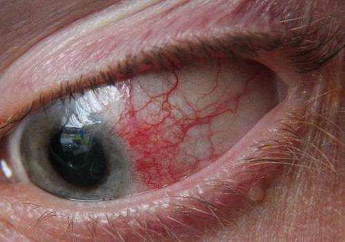 Signs and Prevention of Fungal Eye Infection From Contact Lenses ...