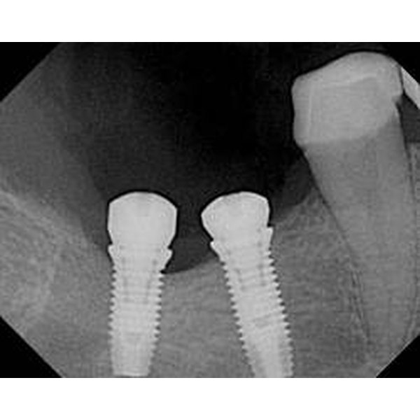 Signs of Dental Implant Infection