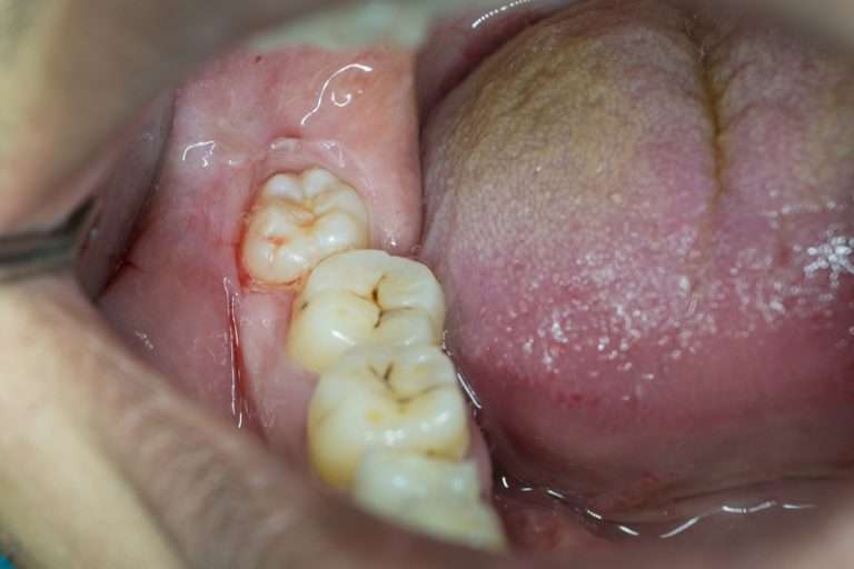 Signs Of Impacted Wisdom Tooth
