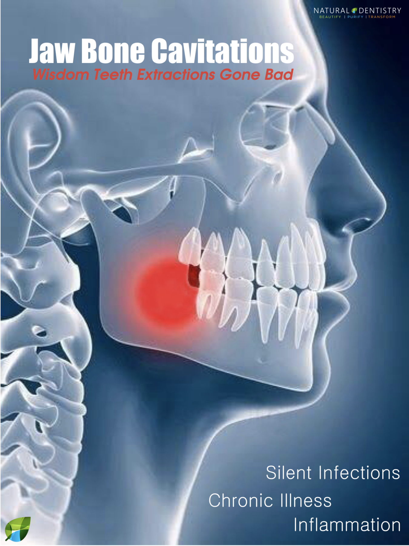 Signs Of Tooth Infection Spreading To Jaw Bone
