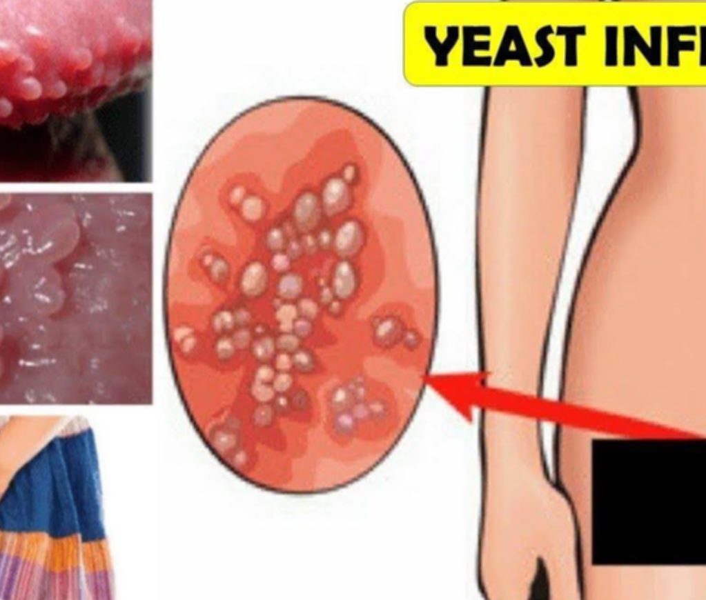Simple Steps to Treat a Yeast Infection Naturally