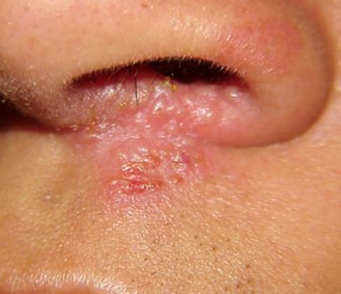 Sinus Contamination Signs Rash