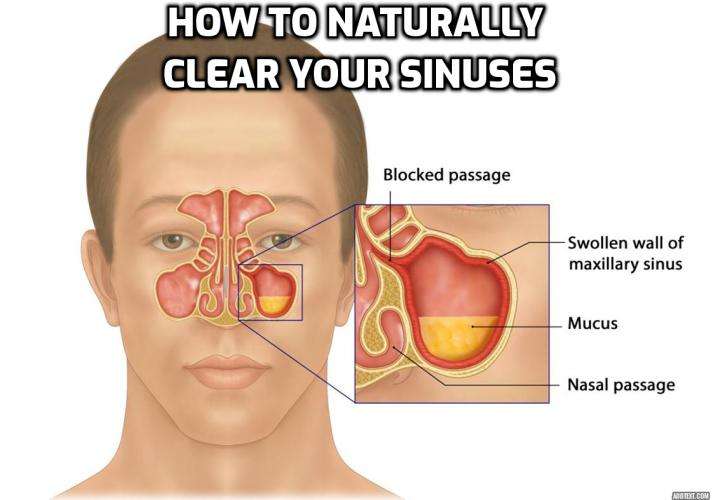 Sinus Inflammation  Causes, Symptoms and Safe Natural ...