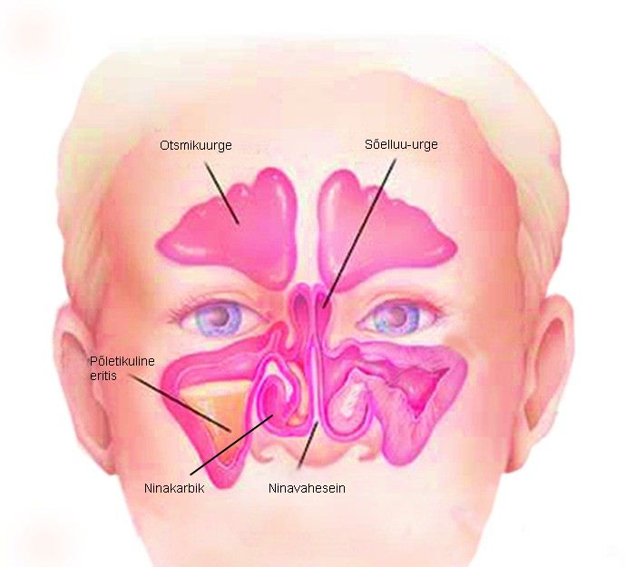 Sinus precautions and cure: 10 Steps to Avoid Sinus Pain and Congestion