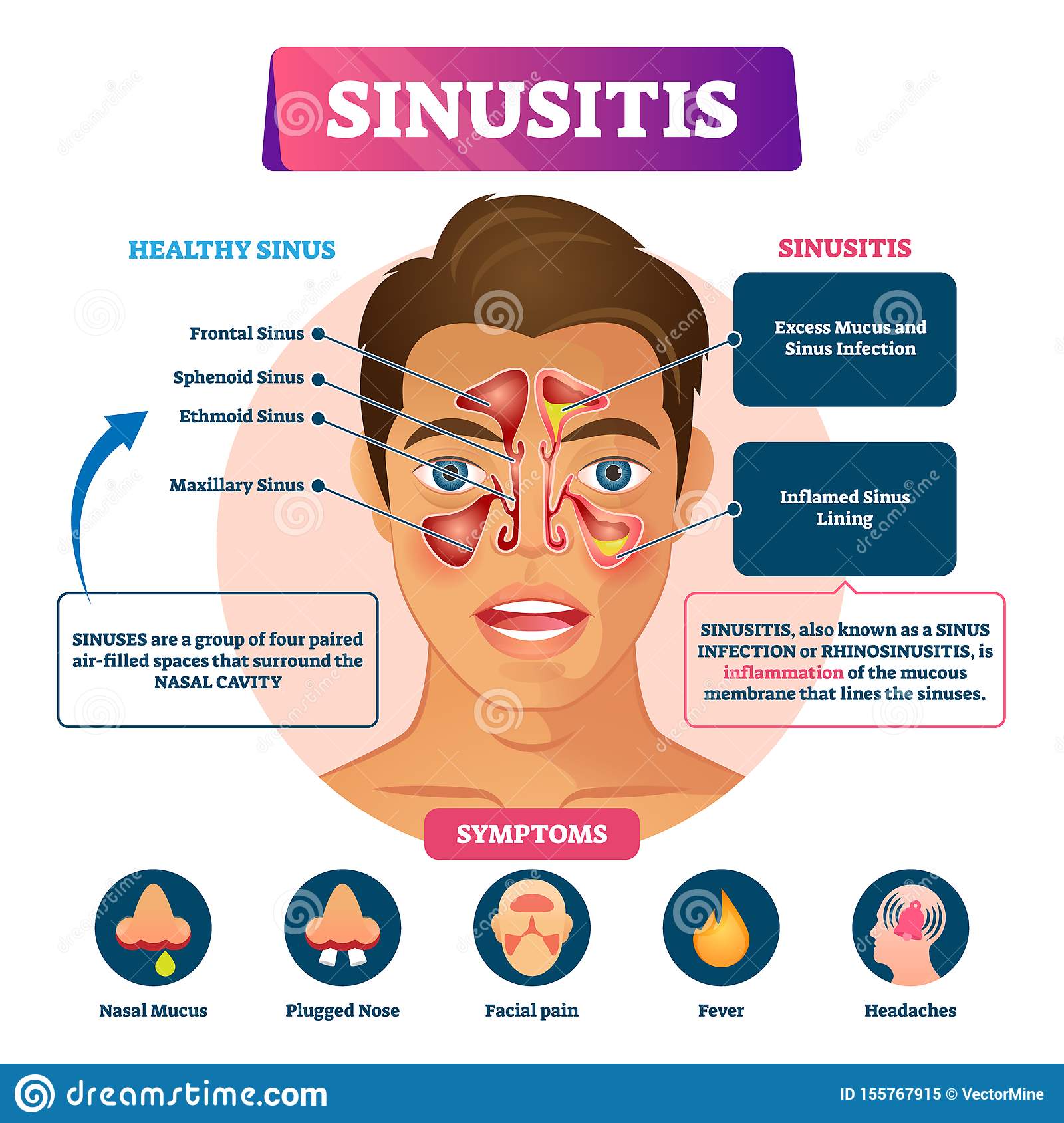 Sinusitis Cartoons, Illustrations &  Vector Stock Images
