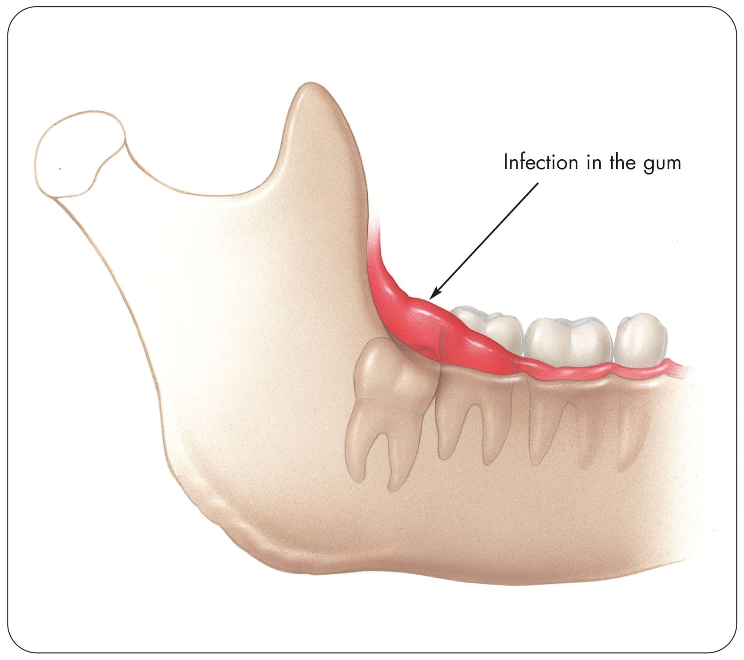 Special problems of impacted wisdom teeth