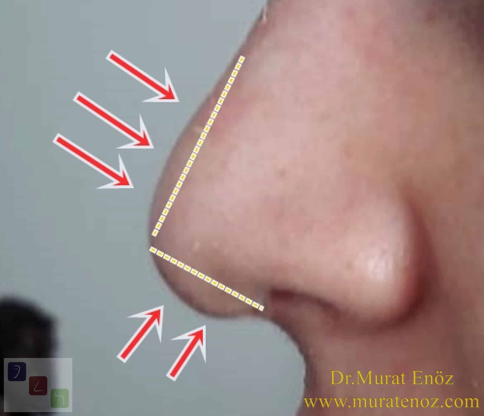 Steroid Injection After Rhinoplasty