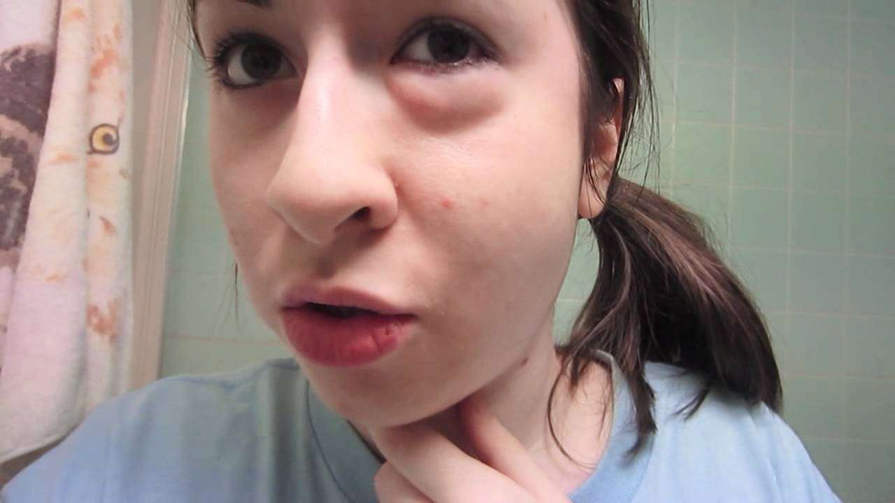 SWOLLEN FACE (Day 1)